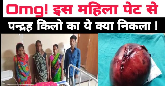 OMG! ऑपरेशन थियेटर में उड़े डॉक्टरों के होश, महिला के पेट से निकला 15 kg का...