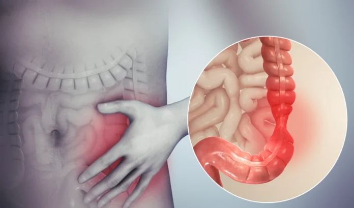 Colon Cancer