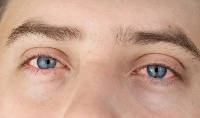 Eye Flu